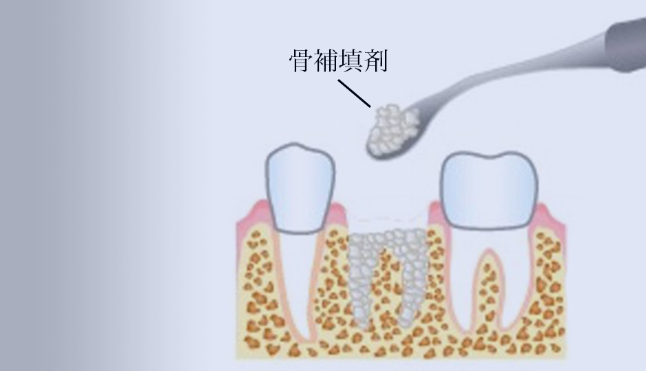 从拔牙阶段开始通过适当的治疗实现高度稳定的种植体